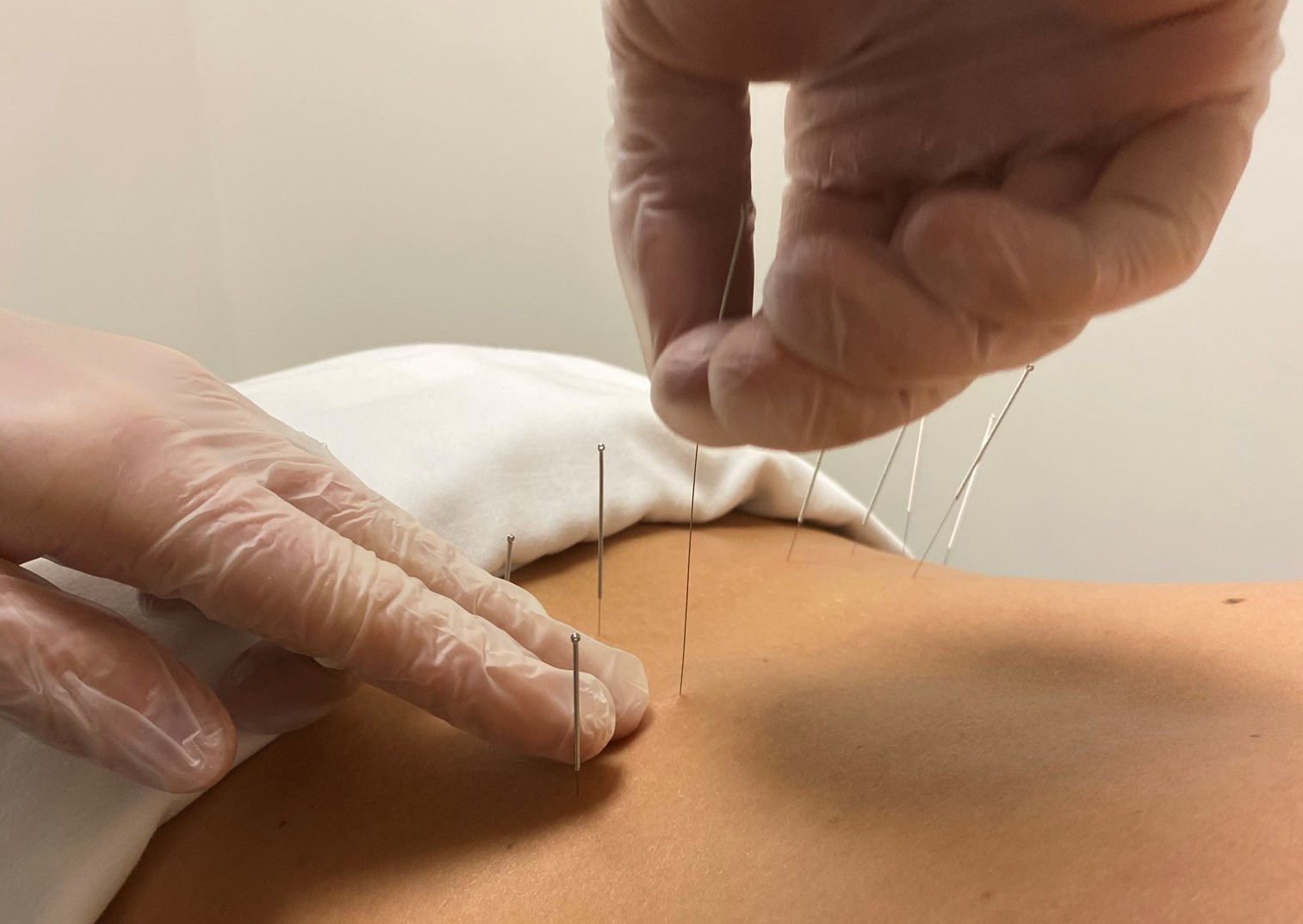 Dry Needling